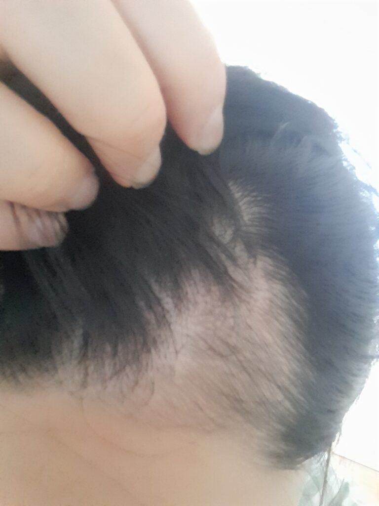 산후탈모로 옆머리 숱이 줄어든 모습