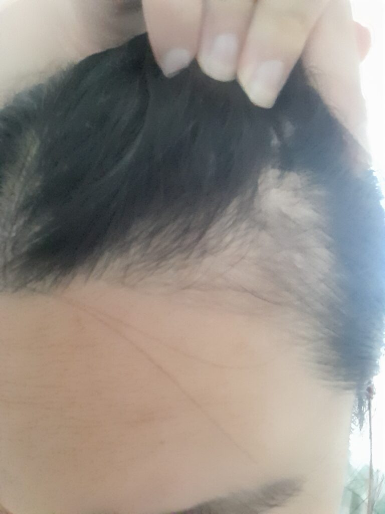 산후탈모로 옆머리 숱이 줄어든 모습