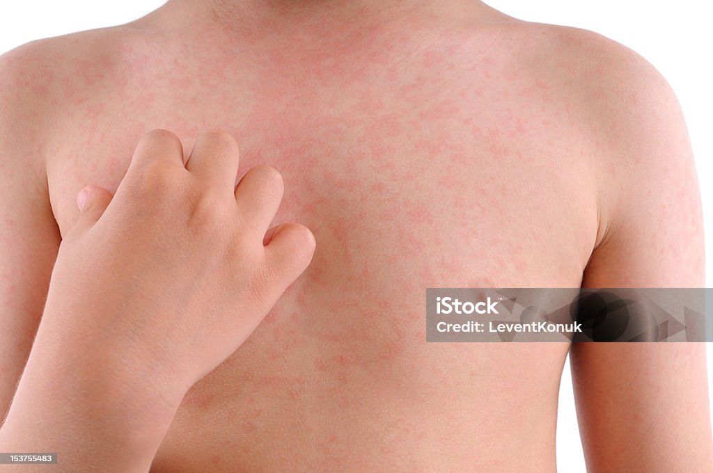 돌발진 증상과 열꽃 구별법|40도 고열 후 발진이 올라오는 이유